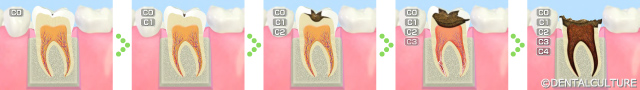 むし歯の発生と進行