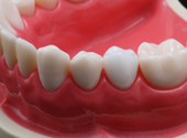 白い歯の模型
